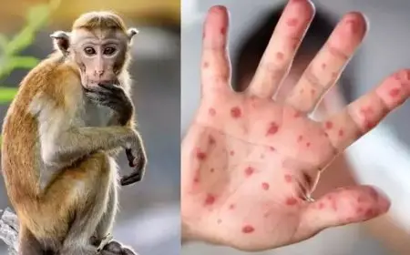 نداء عالمي لمواجهة جدري القرود.. تفاصيل خطة الصحة العالمية لمنع انتشاره