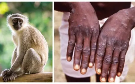 الصحة العالمية توافق على اعتماد لقاح جدري القرود للأطفال والمراهقين