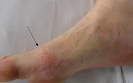 أدوية تؤدي إلى ارتفاع حامض البوليك في الدم