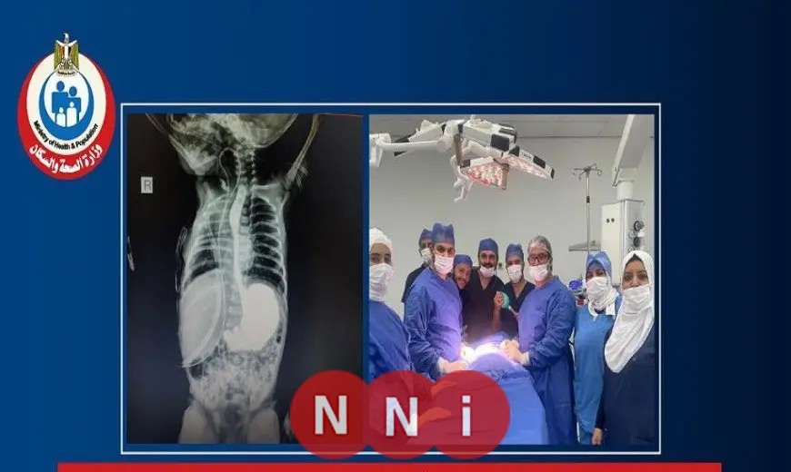 جراحة نادرة تنقذ حياة رضيعة في الثالثة من عمرها من خطر الاختناق بمستشفى الخانكة