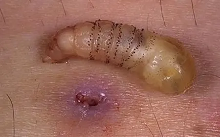 أمريكا تسجل أول حالة إصابة بشرية بالدودة الحلزونية.. وقلق من انتشار المرض