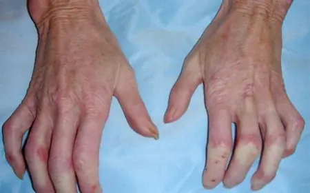 تفشي فيروس جلدي في مدرسة بالجيزة تعليم الجيزة يصدر توضيحًا عاجلًا ويتخذ إجراء سريعًا