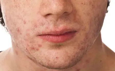 تعليم الجيزة يرصد 4 حالات إصابة بحبوب في اليدين بين الطلاب