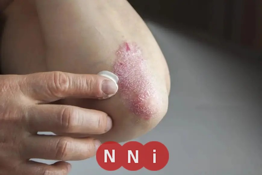 كيفية مواجهة تزايد أعراض الصدفية في الشتاء ولماذا تحدث؟