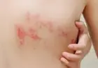 سماح البكري تشرح: الحزام الناري عدوى فيروسية تصيب الأعصاب الطرفية وتسبب آلامًا مبرحة