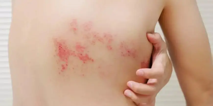 سماح البكري تشرح: الحزام الناري عدوى فيروسية تصيب الأعصاب الطرفية وتسبب آلامًا مبرحة
