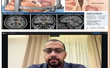 تفاصيل مثيرة حول عملية دقيقة لإنقاذ مريض مصاب بشلل رعاش