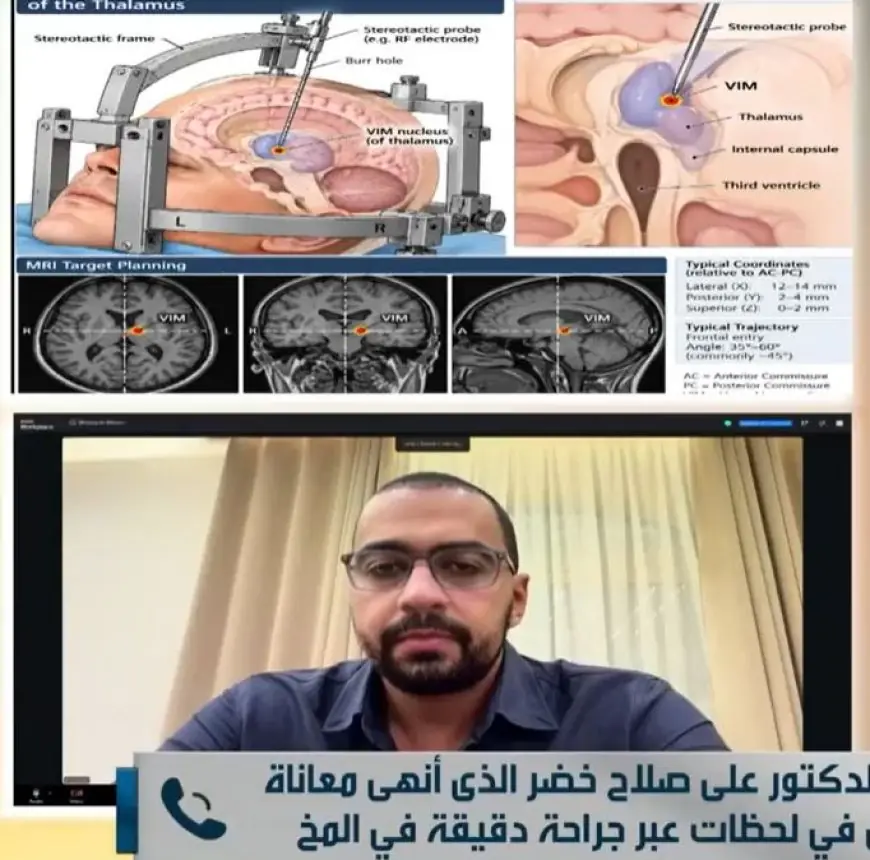 تفاصيل مثيرة حول عملية دقيقة لإنقاذ مريض مصاب بشلل رعاش